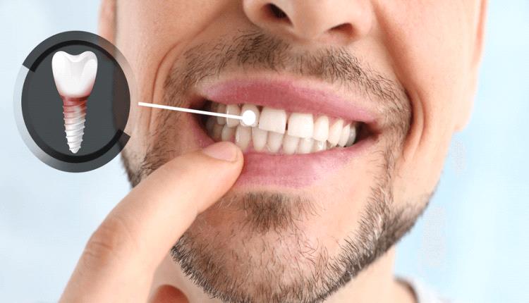 زراعة أسنان حقيقية من جسد المريض نفسه لأول مرة في التاريخ .. اعجاز علمي بديع! 