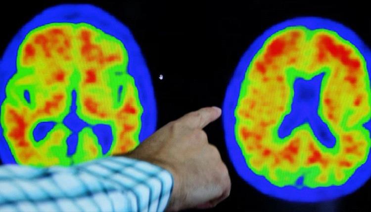دراسة جديدة تكشف دور أوميغا 3 في تفشي الزهايمر بين النساء