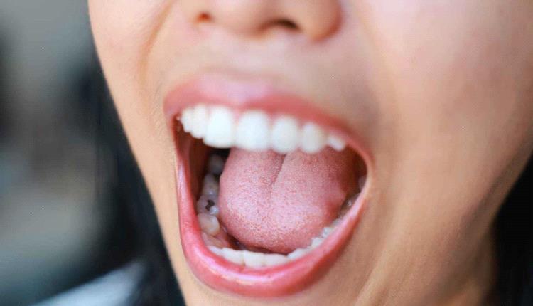 بكتيريا الفم تسهم في تصلب الشرايين والنوبات القلبية
بكتيريا الفم