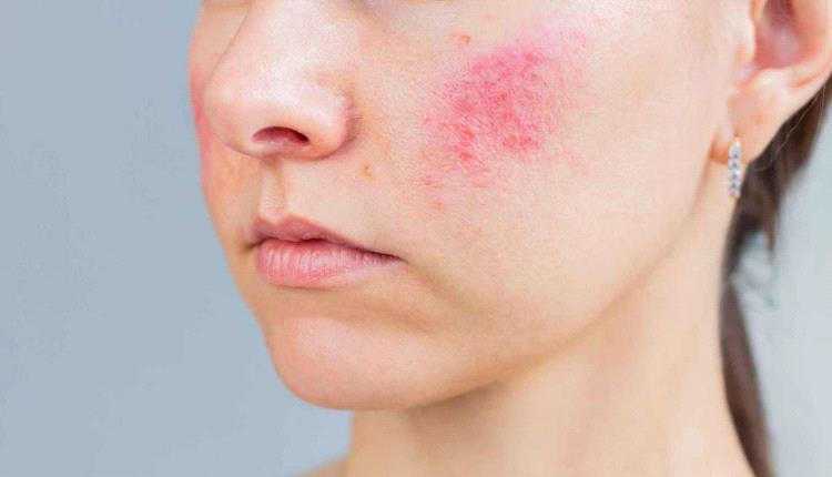لماذا يزداد احمرار الوجه مع التقدم في العمر؟