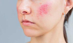 لماذا يزداد احمرار الوجه مع التقدم في العمر؟