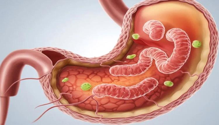 دراسة حديثة تربط جرثومة المعدة بالسرطان.. ما طرق الوقاية والعلاج