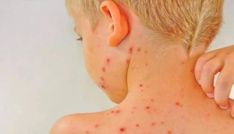 شومر يدعو إلى إعلان حالة طوارئ صحية في الولايات المتحدة بسبب الحصبة