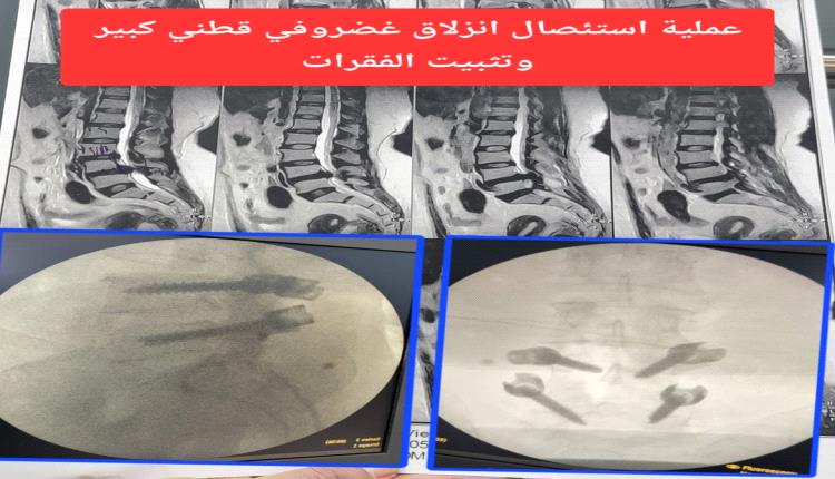 عدن تحقق نقلة نوعية في جراحة العمود الفقري.. نجاح 24 عملية دقيقة خلال شهر مايو الفائت
