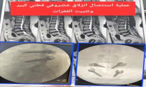 عدن تحقق نقلة نوعية في جراحة العمود الفقري.. نجاح 24 عملية دقيقة خلال شهر مايو الفائت