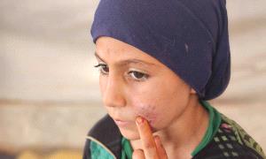 درعا السورية تسجل 133 إصـ.ـابة بمرض اللاشمانيا