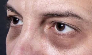 الهالات السوداء.. مؤشر خفي على أمراض داخلية خطيرة