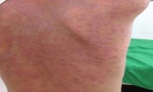 الضالع .. عشرات الإصـ.ـابات بمرض "الجدري" تجتاح منطقة بلاد الأحمدي بالأزارق