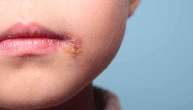 عدوى جلدية شائعة يُساء تشخيصها.. كيف تعرفها قبل أن تتفاقم؟