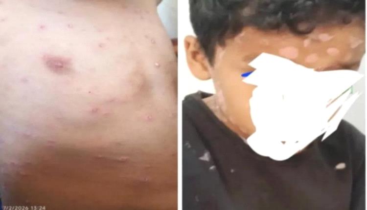 وسط تجاهل السلطات المحلية .. تزايد حالات الإصابة بفيروس الجدري المائي في هذه المحافظة!
