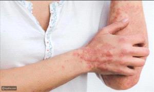 التهاب الـ.ـدم: الأعراض، المراحل، والتحذيرات الطبية