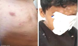 وسط تجاهل السلطات المحلية .. تزايد حالات الإصابة بفيروس الجدري المائي في هذه المحافظة!
