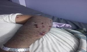 إصابة مواطن بجروح جراء انفجار لغم زرعته ملي.شيات الحو.ثي شرق مديرية حيس
