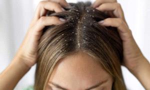 4 أسباب خفية وراء قشرة الرأس المستمرة في الشتاء ..