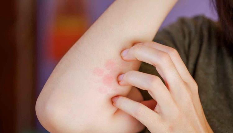 احذر حكّ لدغة البعوض.. دراسة تكشف خطرًا خفيًا يدمر جلدك

