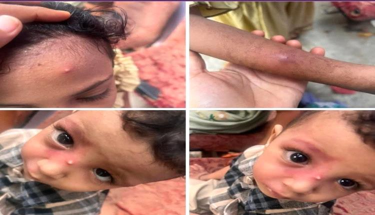 عدن تحترق والناس تموت .. "والرعاة والمنظمات الدولية شهود زور"