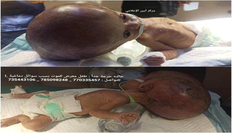 حالته حرجة جداً : طفل معرض للموت بسبب سوائل دماغية .!