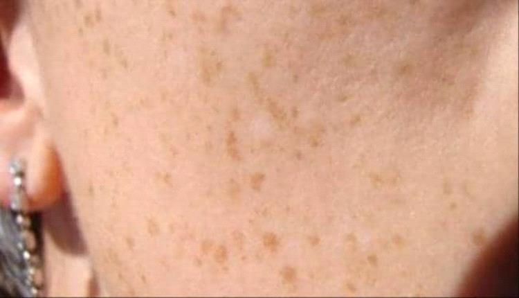ما الأسباب الرئيسية وراء ظهور بقع في الجلد.. تعرف عليها